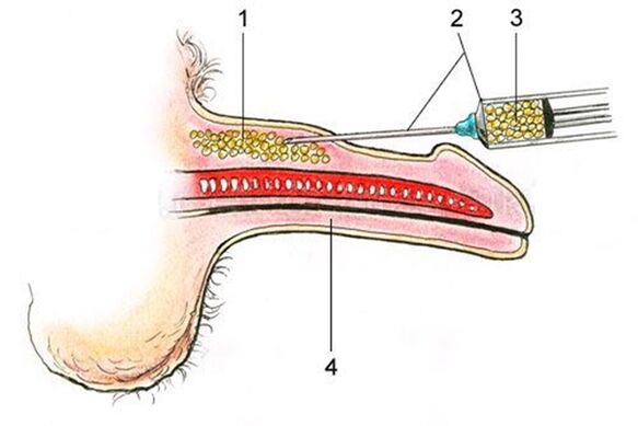 Ліпофілінг - введення жирової тканини в стовбур пеніса